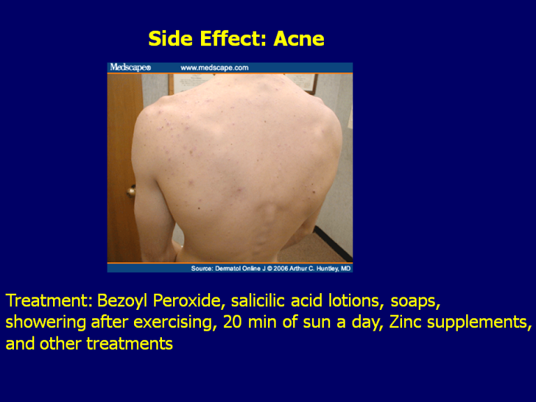 Testosterone and Acne What You Need to Know Testosterone Wisdom